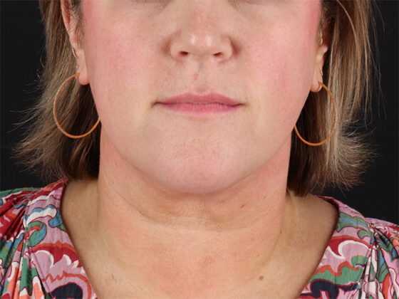 Case # 2 after photo